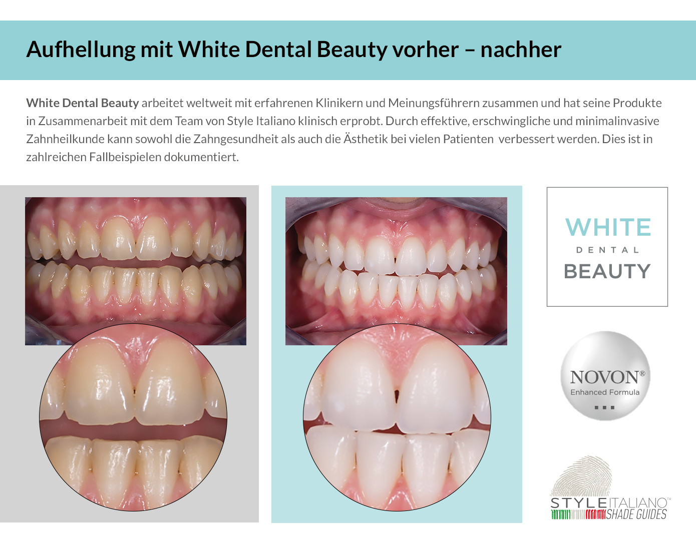 White Dental Beauty. Vorher - Nacher