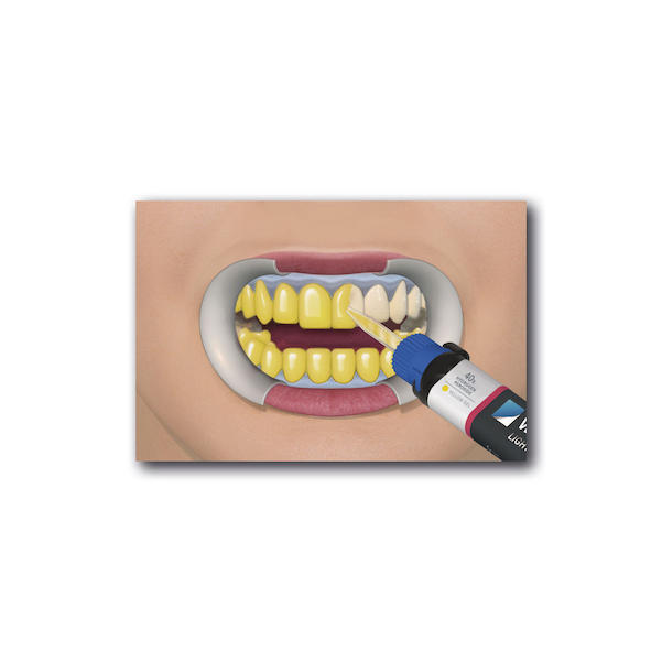 POWER WHITENING YF 40 % - 6-Patienten-Kit