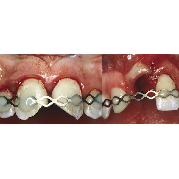 Titanium Trauma Splint